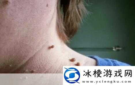 肛门口摸到个软软的肉要怎么消除：1.-如何有效缓解肛门周围软组织的异常感