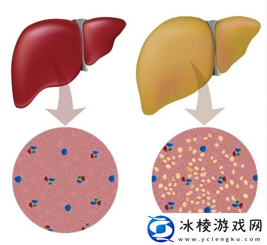 大学生月瘦20斤却患上脂肪肝