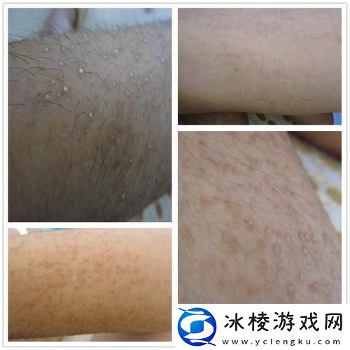 身体豆粒谜团：科技视角下的诡异疙瘩